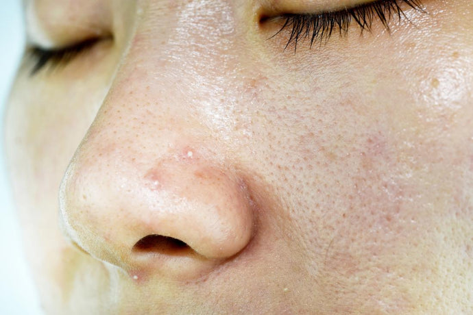 Skin Care Tips for Oily and Acne Skin